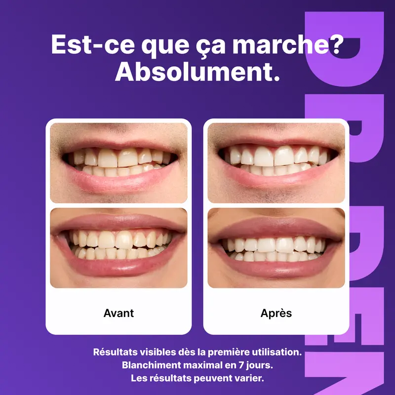 LUMSMILE® - Bandes blanchissantes
