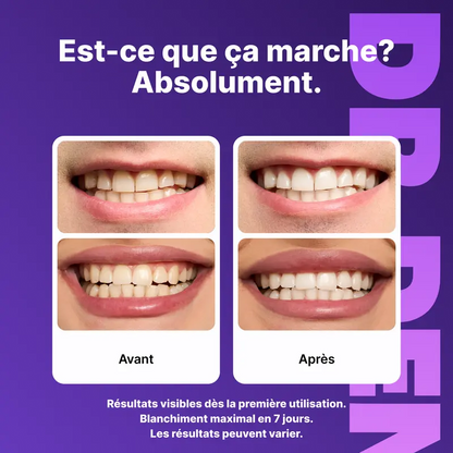 LUMSMILE® - Bandes blanchissantes